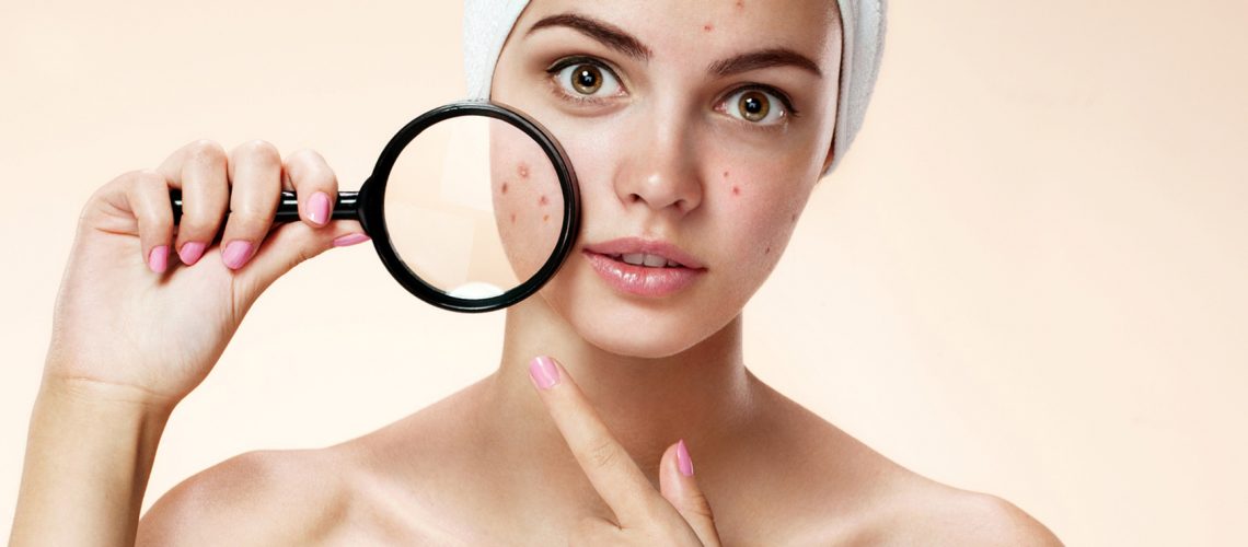 3 Ways CBD Oil Helps Reduce Acne Caused by Hormones
